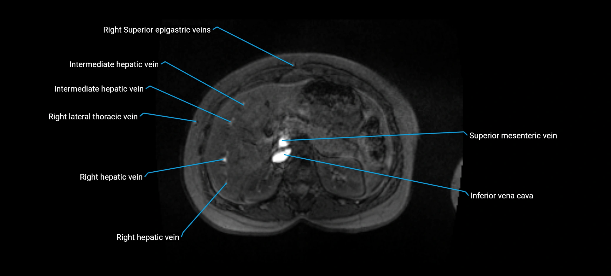 MRV abdomen pelvis & lower limb axial cross sectional anatomy labelled MRI image 52 (1).webp